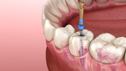 Afbeelding van cursus Assisteren bij endodontische behandelingen