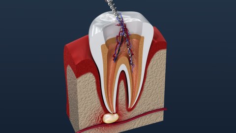 Afbeelding van cursus De endopocket